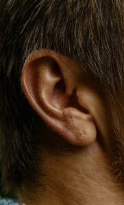 What is Auricular Therapy(Auricular Therapy क्या होती है?)